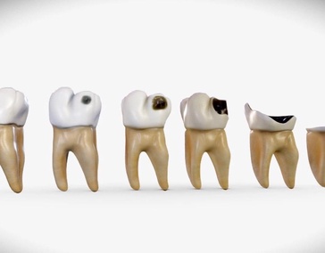 Найден неожиданный метод борьбы с кариесом 