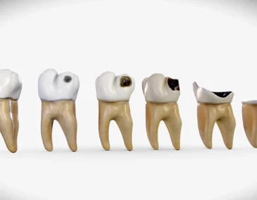 Найден неожиданный метод борьбы с кариесом 