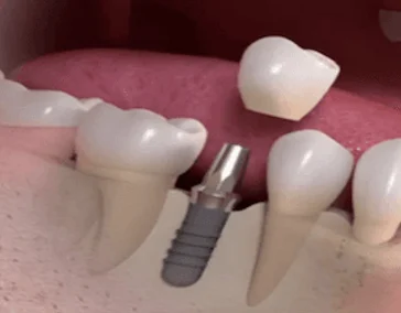 Имплантация зубов