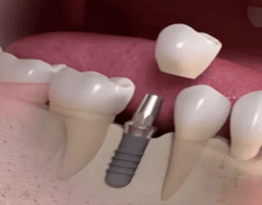 Имплантация зубов