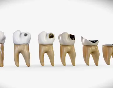 Найден неожиданный метод борьбы с кариесом 